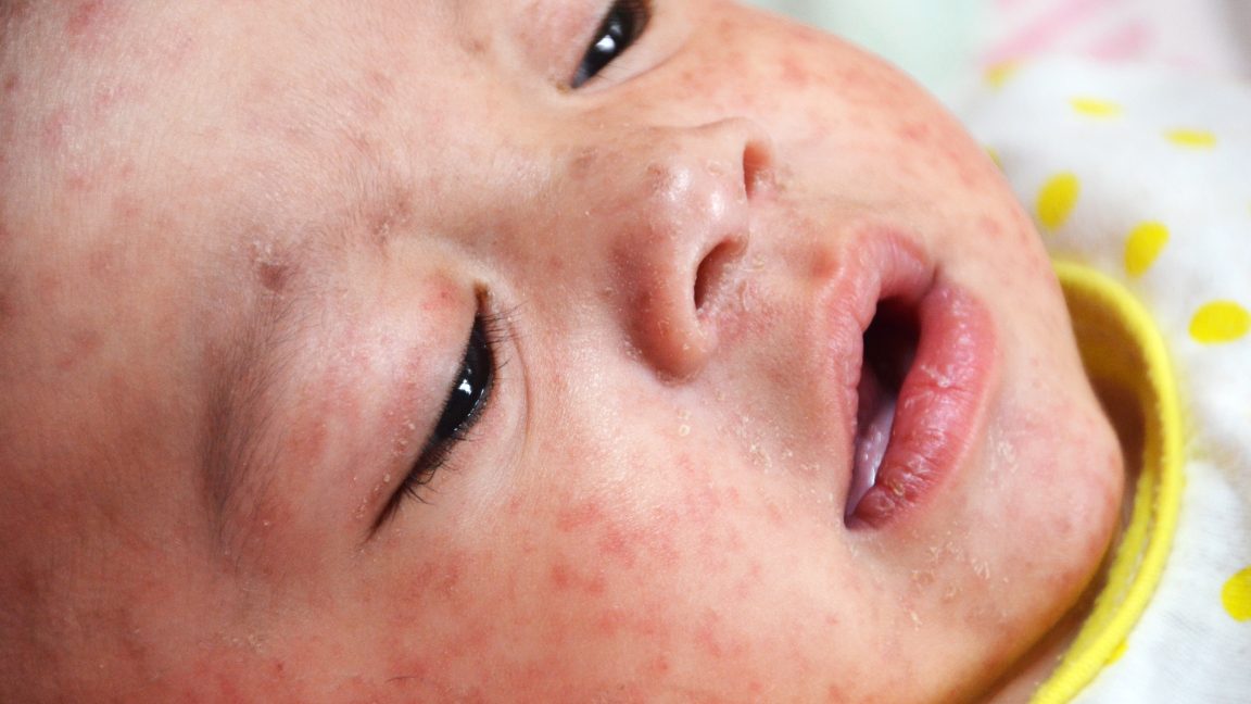 Dead babies, critically ill kids: Pediatricians make moving plea for vaccines